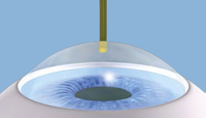 Trans-PRK Augenlaser-Behandlung - Schritt 1